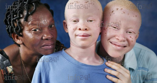 Journée internationale&nbsp;: Sacri International dénonce les crimes rituels contre les albinos